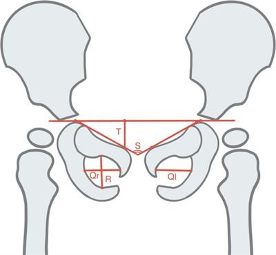 Application of deep-learning–based artificial intelligence in acetabular index measurement